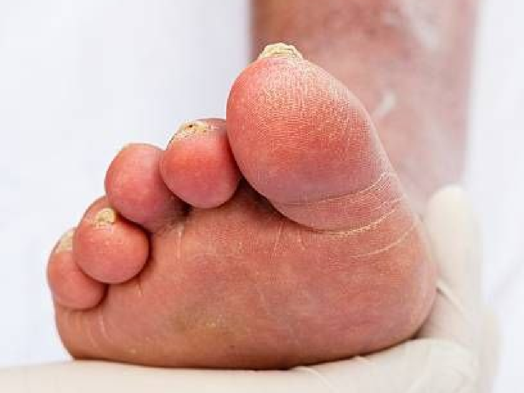 Обработка грибковых поражений